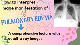 Pulmonary edema Xrays manifestation II How Edema fluid can be diagnosed on chest Xrays [upl. by Dorina]