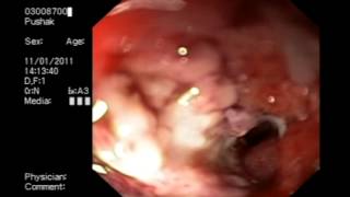 Stomach Abnormal Post Surgical Anatomy Uncovered Endoscopic Stent Occluded with Granulation Tissue [upl. by Francine]