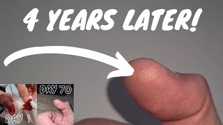 4 Years Later after slicing my finger open [upl. by Fiedler]