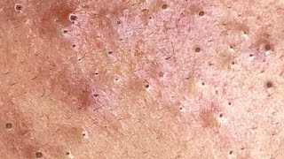 Big Cystic Acne Blackheads Extraction Blackheads amp Milia Whiteheads Removal Pimple Popping 0029💆 [upl. by Raddi124]