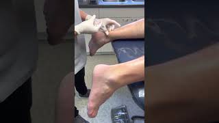 Lyftogt perineural injection therapy mid achilles tendonopathy [upl. by Neik475]