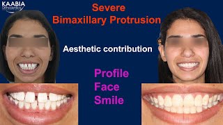 Severe Bimaxillary protrusion  Aesthetic contribution  Profile  Face and Smile [upl. by Holman]