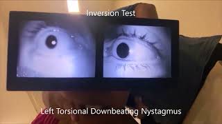 Concurrent Posterior Cupulolithiasis and Short Arm Posterior Semicircular Canalolithiasis [upl. by Ahsia]