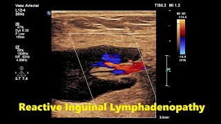 Reactive Inguinal Lymphadenopathy  Ultrasound  Doppler  Case 03 [upl. by Isabel]