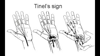 Tinels Sign Clinical Test Definition Procedure Meaning Positive Negative Associated condition [upl. by Ellenij]