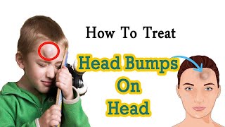 How to Get Rid of Head Bump Naturally at Home  Home Remedies for Head Bump  Goose Egg [upl. by Uzia]