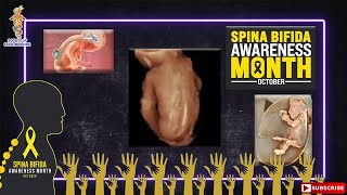 SFM Spina Bifida Awareness Webinar [upl. by Eneluj]