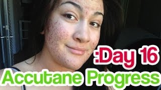 Day 16 Accutane SEVERE Acne Update WORKING FAST [upl. by Emlynne]