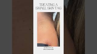 Treating a small skin tag using ThermoClear machine [upl. by Brazee]