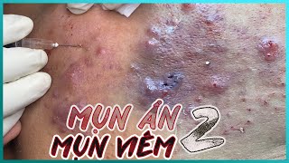 Big Cystic Acne Blackheads Extraction Blackheads amp Milia Whiteheads Removal Pimple Popping [upl. by Rainer]