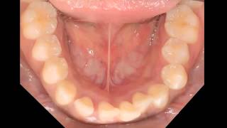 Aggressive periodontitis [upl. by Spurgeon252]