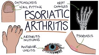 Psoriatic Arthritis [upl. by Belding]