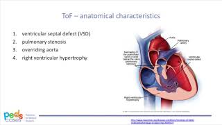 Tetralogy of Fallot [upl. by Apps]