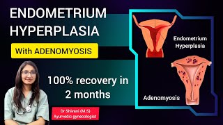 Endometrial hyperplasia with adenomyosis  case discussion ayurvedic treatment ayurvedictreatment [upl. by Niple]