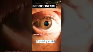 IRIDODONESIS Trembling of IRIS eyetuberoptomeyehealtheyecareshorts [upl. by Anev428]