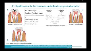 Lesiones endodónticas periodontales II [upl. by Veator862]