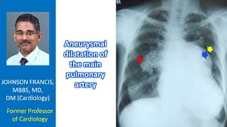 Aneurysmal dilatation of the main pulmonary artery [upl. by Kcered868]