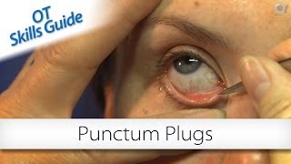 OT skills guide punctum plugs [upl. by Fronia]