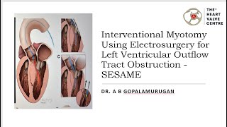 Interventional Myotomy Using Electrosurgery for Left Ventricular Outflow Tract Obstruction  SESAME [upl. by Yna]