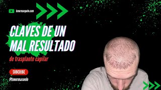 CLAVES DE UN MAL RESULTADO DE TRASPLANTE CAPILAR [upl. by Joslyn]