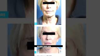 The Best Laser Treatment for Skin and Wrinkles [upl. by Aerol604]