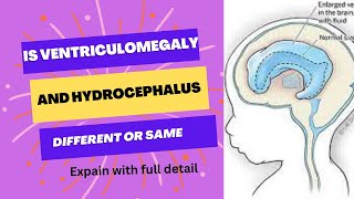 Explain with detail ventriculomegaly or hydrocephalus [upl. by Jerrol]