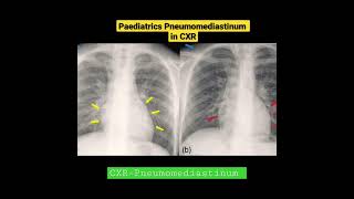 CXR  Paediatrics Pneumomediastinum Sign  Radiology [upl. by Hameerak799]