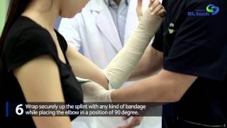 APPLICATION VIDEO LONG ARM SPLINT [upl. by Anned]