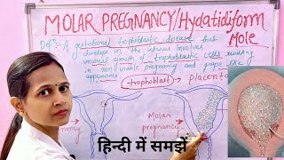 Molar Pregnancy Hydatidiform MoleImportant for all nursing examsअसमान्य गर्भावस्था [upl. by Mert8]