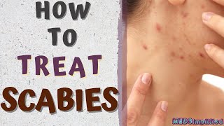 HOW TO TREAT SCABIESscabies treatment at home [upl. by Benedict]