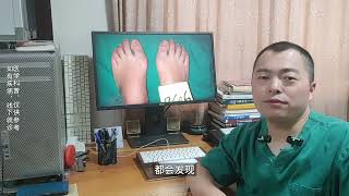 hallux valgus 年轻拇外翻案例，年轻拇外翻什么时候手术比较合适？ [upl. by Nimesh828]