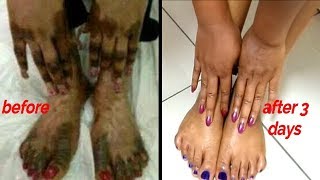 3 Days Guarantee Remove Bleaching Cream Reaction On Hands And Legs At Home [upl. by Mairem]