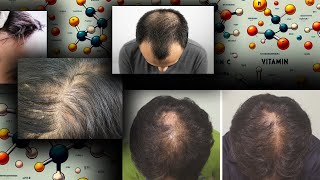 Vitamins and Minerals on Hair Loss Finasteride and Dutasteride [upl. by Atnahs161]