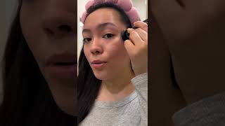 Consistency is the key to improving your acne scars acne acnescars microneedling [upl. by Ahtelahs]