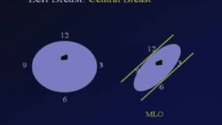 Correlating Mammography Ultrasound and MRI [upl. by Michey]