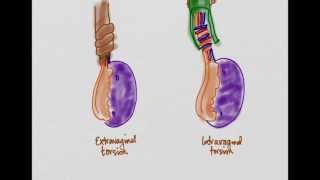 Testicular Torsion [upl. by Crisey517]