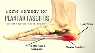 Plantar Fasciitis Home Remedies  How to Treat Plantar Fasciitis [upl. by Merwin]