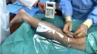 Continuous Popliteal Nerve Block [upl. by Naaitsirhc625]