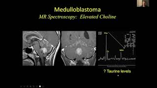 Neuroradiology of Medulloblastomas  Dr Suresh Mukherji MD MBA FACR amp Dr Hemant Parmar MB BS [upl. by Ogires]