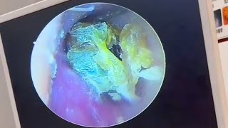 Super thick fungal dry slices in the ear canal [upl. by Eselahs]