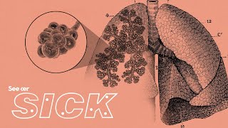 Heres Why Pneumonia Is Still So Deadly [upl. by Tades403]