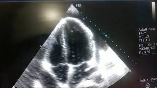 CARDIAC TAMPONADE ECHO APICAL FOUR CHAMBER VIEW [upl. by Tnek814]