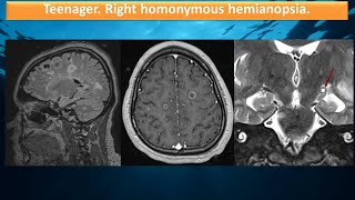 Teenager Homonymous hemianopsia [upl. by Raila]