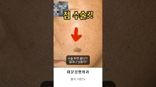 점 제거 수술 흉터 어떨까 점 레이져 수술 피부과 성형외과 병원 흉터 nevus removal plastic surgery hospital seoul korea아문TV [upl. by Arliene]