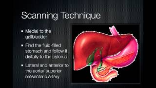 pyloric stenosis [upl. by Brittnee]