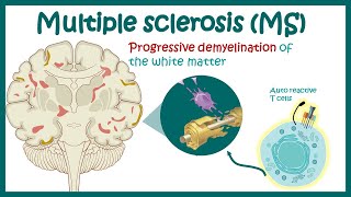 Multiple Sclerosis Overview 2024 [upl. by Onilegna]