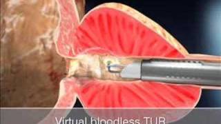 TURis Plasma Vaporization [upl. by Egiedan]