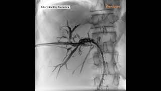 BILIARY STENTING PROCEDURE [upl. by Halfon]