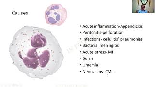 Neutrophilia  GAME 44  Pathology practical slides  MBBS  SRM  Dr GSS  University questions [upl. by Duma]