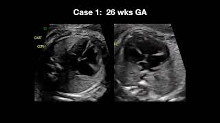 2023 Fetal Echocardiography Normal and Abnormal Hearts  A Video CME Teaching Activity [upl. by Ramiah]